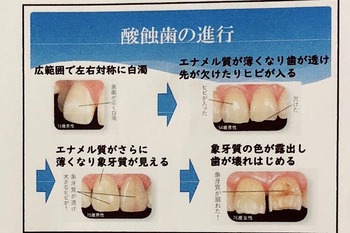 酸蝕歯　杉田デンタルクリニック.jpg